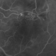 Hypertensive Retinopathy Hypertensive Retinopathy